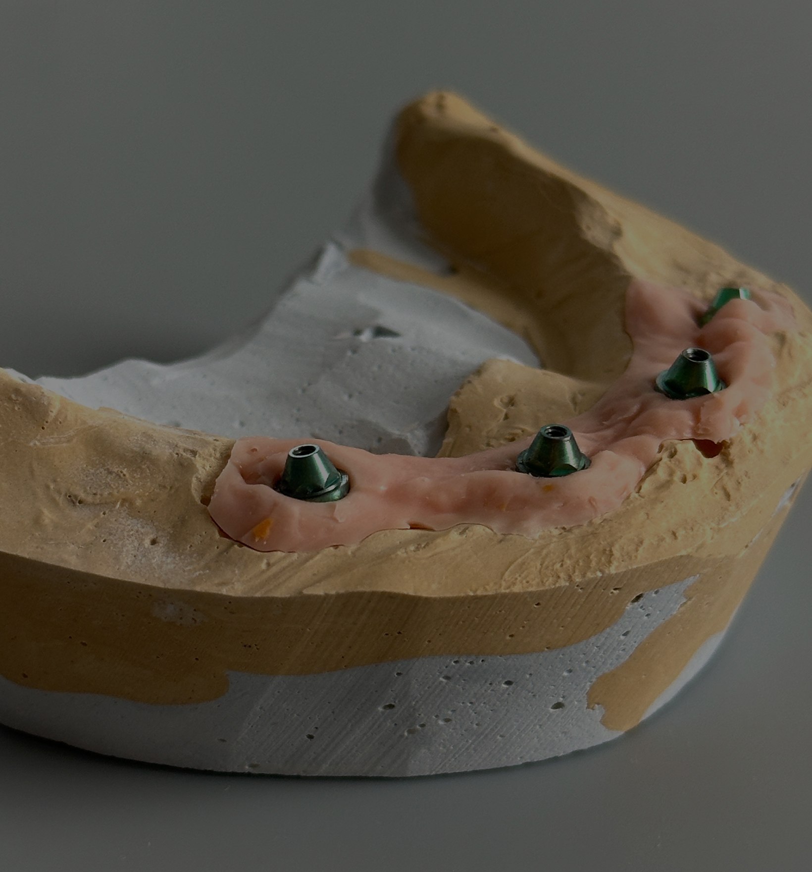 Дентальная имплантация