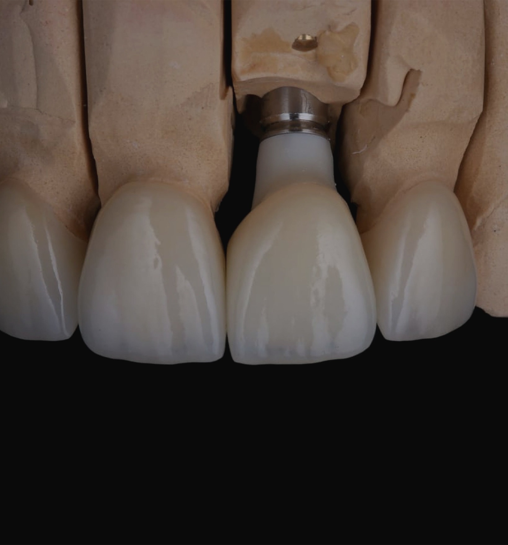 Протезирование зубов