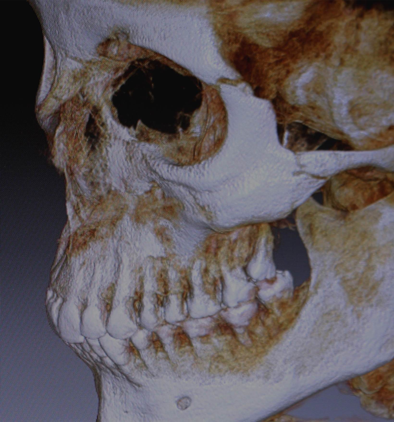 Компьютерная томография